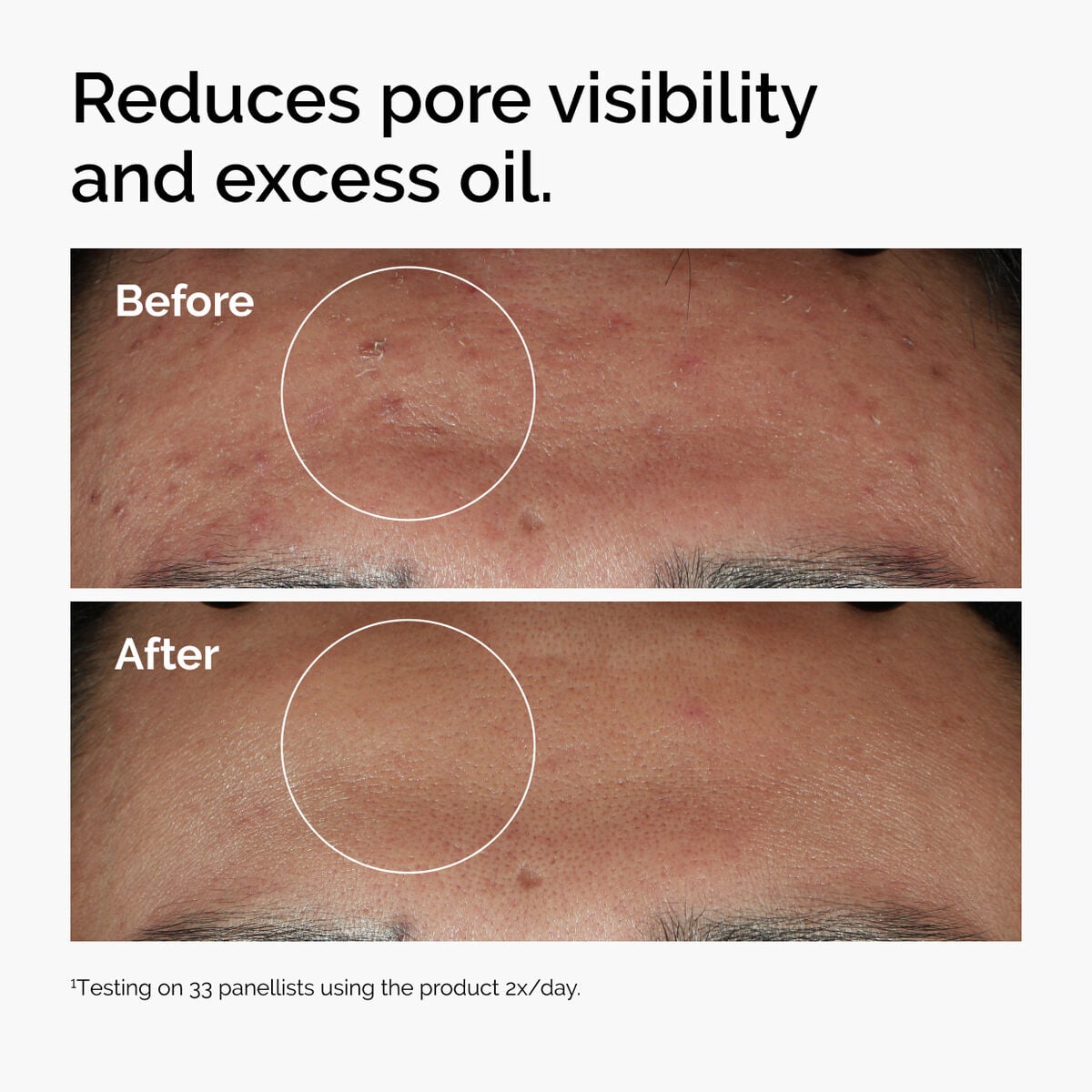 niacinamide-10-zinc-1-v6 ord-niacinamide-zinc-blemish-serum-before-after-pores.jpg