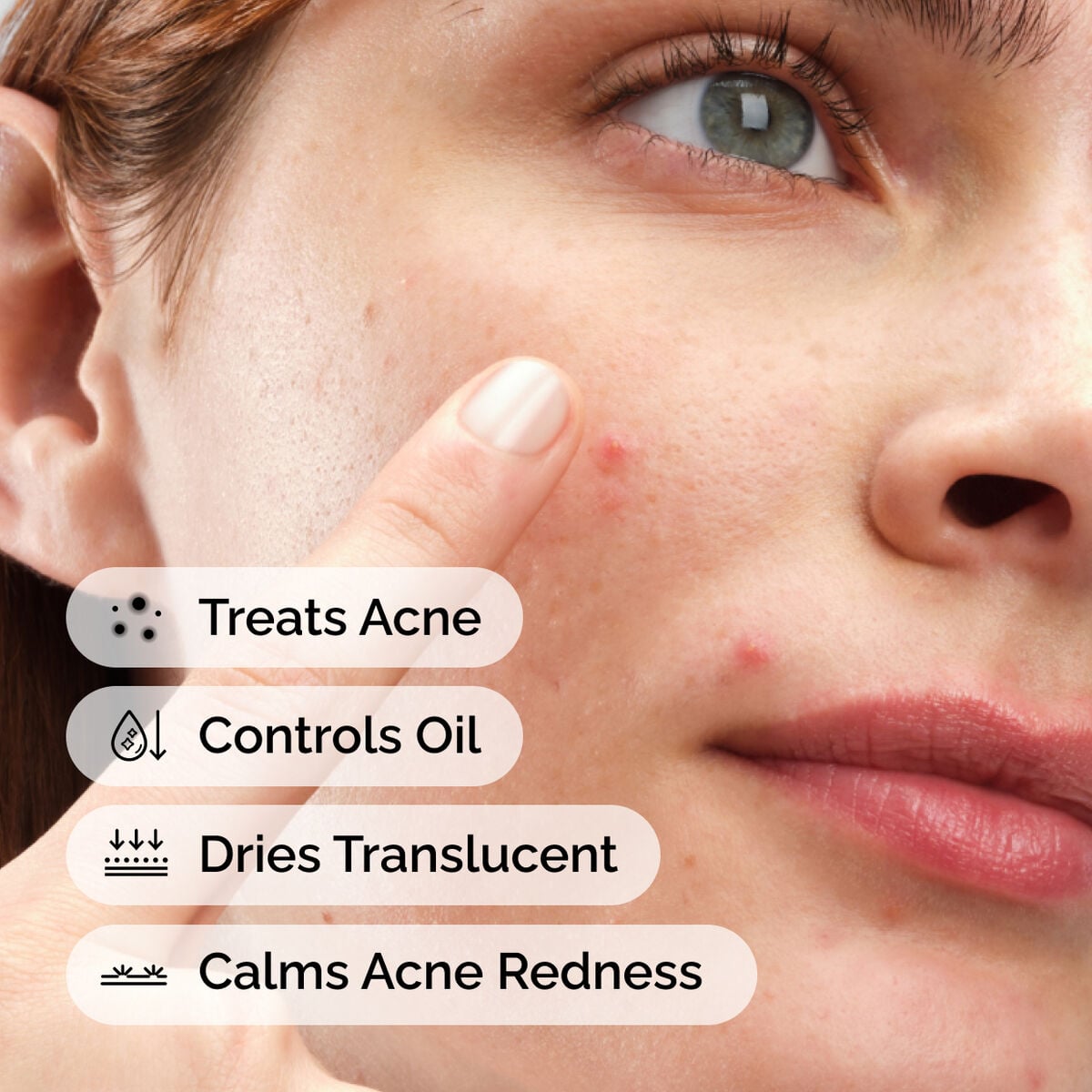 sulfur-10-powder-to-cream-concentrate-w0 ord-sulfur-10pct-powder-to-cream-concentrate-model-application-with-benefits-acne.jpg