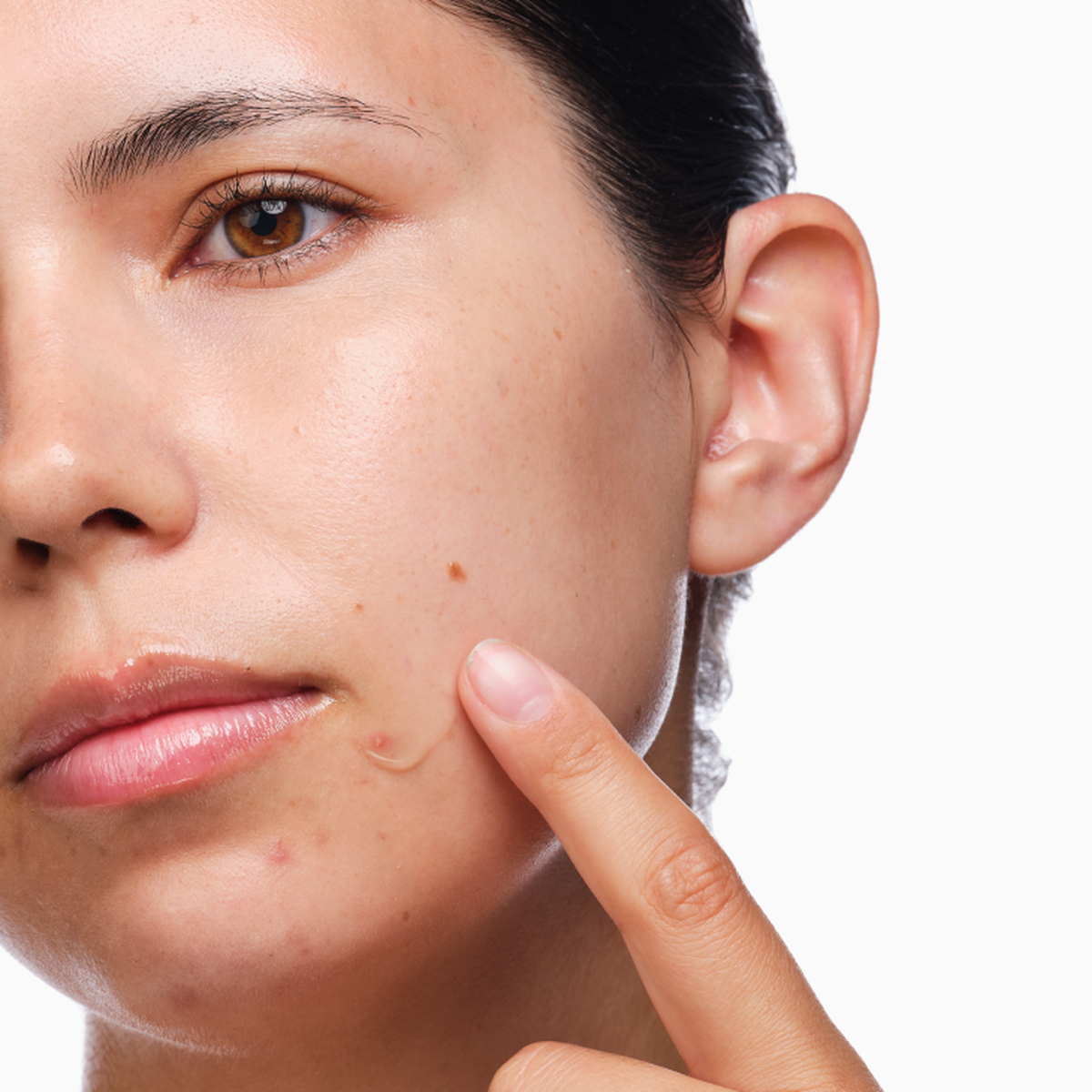 the-acne-set-o9 rdn-the-acne-set-application.png